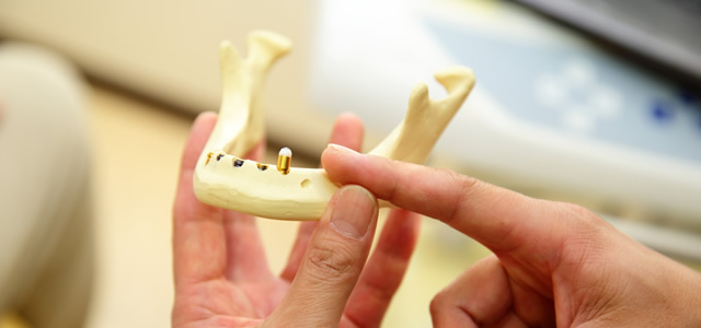 インプラント治療について